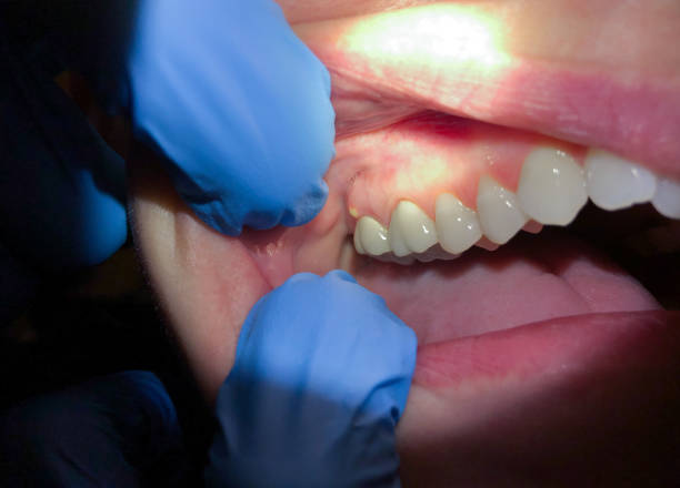 Best Emergency Denture Repair in Clemson, SC