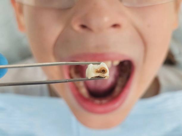 Best Emergency Treatment for Oral Infections in Clemson, SC